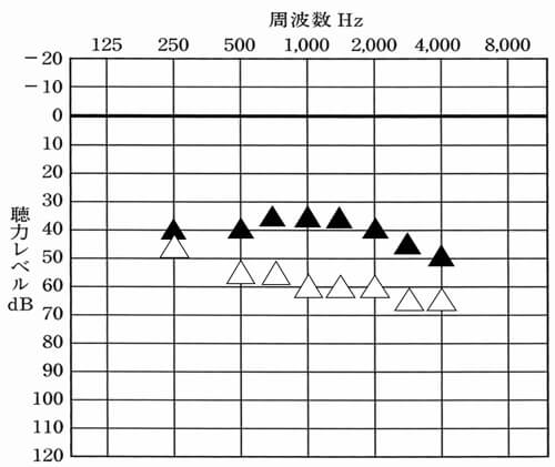 体感で合わせた後、測定を行うことで、初めて自分の状態がわかるようになる。なお、補聴器が初めての方は、初め高い音が気になりやすい傾向が出るので、2000Hz〜は、下げてあげると使いやすくなったりもする。これは、なかなか補聴器を使えない方でも同様だ。