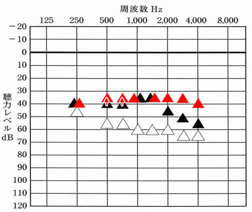 それでも聞こえを改善したい。という場合は、きつく感じる音を確認し、それ以外の部分を改善させる。という方法もある。仮に紙の音がうるさくて、これ以上は、厳しい。となった場合は、その中心部分の音は、大きくせず、それ以外の足りない部分を補う。という考えもある。数値にすると、このような事も相談しやすくなる。