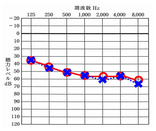 一般的な両耳とも同じような聞こえのケース。このようなケースは、生まれつき聞こえにくい方や老人性難聴の方によく見られる。