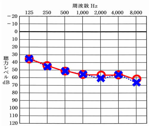 両耳とも同じような聴力の場合は、バランスは、整えやすい。体感で確認していくことが多いが、場合によっては、測定を通じて、状況の把握をし、バランスを確認していく。