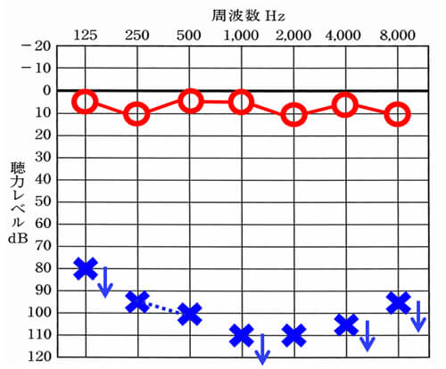 こちらは、右側は、正常で、左側が全然聞こえないケース。