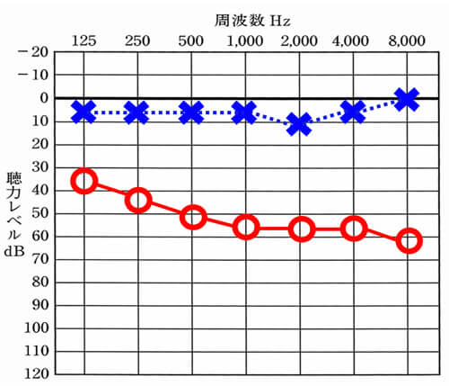 聴力低下が補聴器で補える範囲である場合のケース。