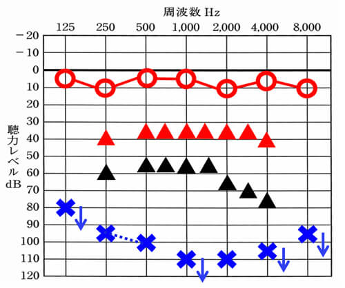 仮にこちらの図の左側(青い×)に補聴器をつけたとすると、▲くらいまで改善できることが多い。しかし、一般的な声の大きさで理解しつつ、少し声が小さい感覚でも理解できるようにするには、赤い△くらいの部分まで改善させる必要がある。その部分まで改善させることは、今現在の技術では、できないため、大きく聴力低下した場合は、聞こえない耳側に補聴器をつけても、聞きにくさを感じやすい。