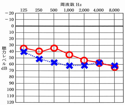左右の聴力が異なる場合は、測定しないとバランスがわからないことが多いので、測定が必須。体感と合わせて、測定し、バランスを知ることが重要になる。