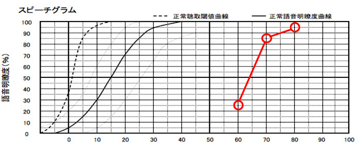 明瞭度は、50%以上なら、良い評価。ただ、できれば、70〜80%ほどは、欲しい。そのようなケースは、片耳に補聴器を装用した方が、バランスよく補えるようになり、よくしやすい。