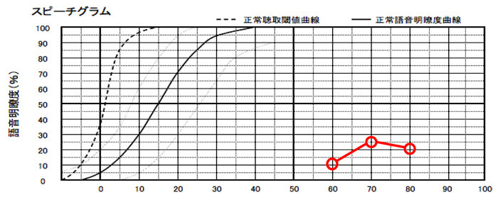 こちらは、明瞭度が低いケース。重要なのは、明瞭度が低い場合、補聴器での改善は、ほとんどできない事。そして、この数値は、補聴器であげることもできないため、低い場合は、クロス補聴器で補った方が聞きにくさは、改善できる。