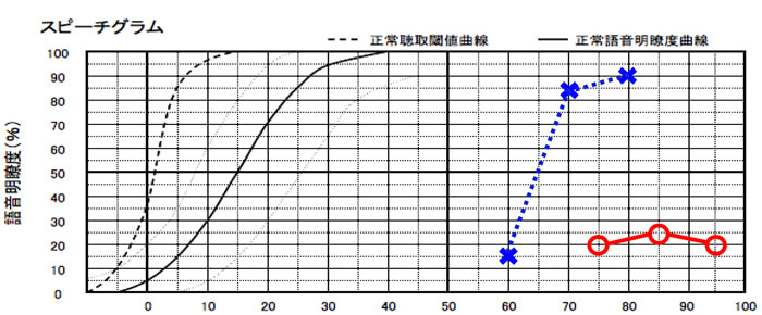 このように片耳が良くもう片耳が非常に悪い場合は、良い耳側を利用できるバイクロス補聴器の方が改善できる傾向がある。明瞭度が低いと、どんなに良い補聴器でも、明瞭度をよくすることができないためだ。