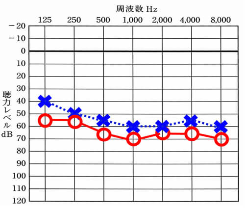 聴力差が少ないケースのモデルケース。こんなに綺麗に出ることは少ないが、少し異なる。というケース。このような場合は、両耳に補聴器を装用し、なるべく聞きにくくならないようにしていくのが、良い。