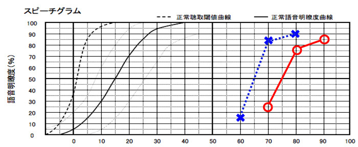 語音明瞭度で判断する場合は、数値の最良値で判断していく。×が左耳側で、右耳が○になる。聴力が近いケースは、別々の難聴になったなど、特殊なケースを除くと、明瞭度が良いケースが多い。