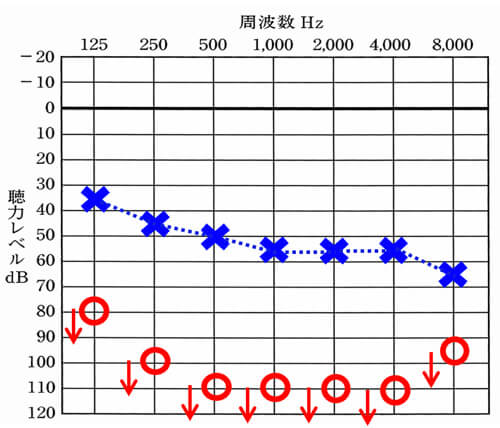 聴力差が大きいケースは、大抵の場合、左右で聞こえにくくなった原因が異なったりする。中には、片耳が全然聞こえないケースも存在する。