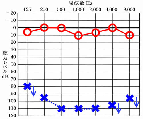 ご相談いただいた方の聴力は、残念ながら聞こえの低下が大きすぎて、補聴器では、効果がほぼ出ないケース。そのため、クロス補聴器という特殊な機器で改善させていくことにしました。