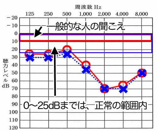 一般の人が聞こえているのは、0〜10dBほど。聴力レベルというのは、人の感覚で作られているため、0に近いと平均的な聞こえになる。そこから、どれだけ聞きにくくなってしまったのか。それを表すのが、こちらのグラフ。