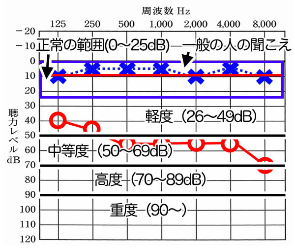 数値の意味合いを記載しますと、このようになります。×が左側で、○が右側を表します。左側は、正常の範囲内ですが、右側は、中等度の割合が高くなっていることがわかります。