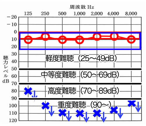 下に矢印(↓)が付いているものは、この音の強さを出した時に反応がありませんでした。という、数値です(スケールアウトと言います)この聴力の場合は、右は、正常の範囲内ですが、左側は、全然聞こえない。という状態です。