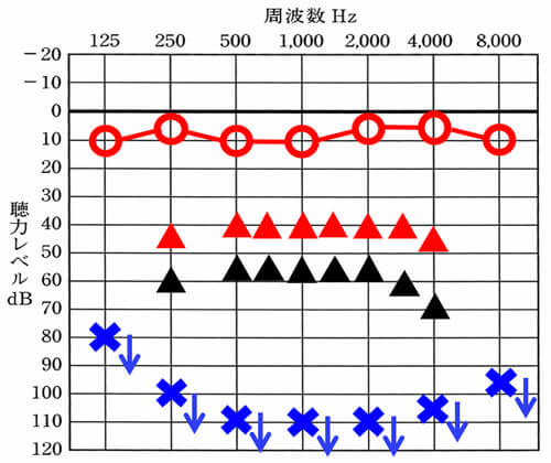 あくまでも私自身が改善してみて感じる傾向ですが、聞こえが重い方を改善させると良くて、▲くらいまで改善できます。しかし、音声を理解したり、聴くには、▲くらいは必要で、実際には、欲を言えば、平均、35dB、30dBくらいは、欲しいところです。なぜなら、正常の人の範囲は、25dBまでですので、それよりも下にくると、下に来るほど、聞きにくさの方が勝ってしまうためです。