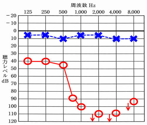 ご自身の声のこもり、内側で響く感覚は、低い音(125〜500Hz)の聞こえが良いと良いほど、感じやすくなります。