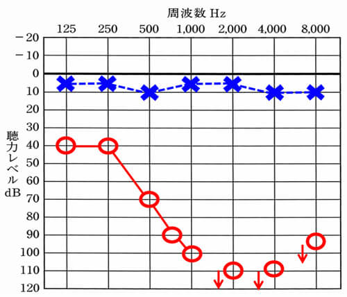 珍しいケースですが、このようにあるところから、急激に聞こえが下がるケースもあります。このような場合も低下している部分が、重度になってきますので、補聴器による改善は、効果が薄くなります。このような場合も総合的に見ると、クロス補聴器の方が改善しやすくなります。