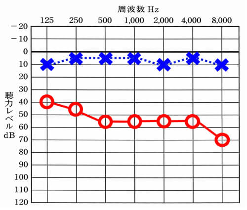 補聴器で聞こえを補う。と考えた場合、聞こえない側に補聴器を装用して、効果が望みやすいのは、このくらいまでです(右側○)。それ以上、低下すると、聞こえる感覚より、聞こえない感覚の方が、徐々に強くなってきます。