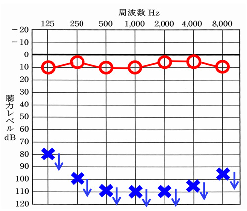 クロス補聴器で改善できるケース①。こちらは、右側は聞こえているのですが、左側が全く聞こえていない状態になります。このようなケースは、補聴器では、改善ができないため、クロスのように聞こえる耳側へ聞こえない耳にくる音を転送してあげることで、改善ができます。