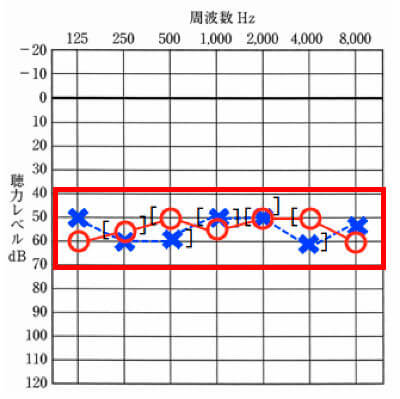 感音性難聴の特徴は、調べた数値が密集している事