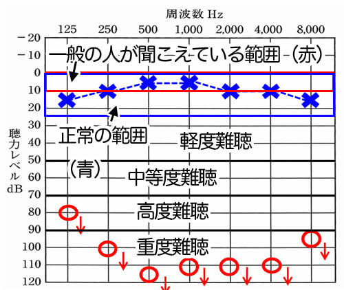 わかりにくいのだが、0〜10dBが一般の人が聞こえているライン。正常の範囲が、0〜24dB。25〜49dBが軽度の難聴で、50〜69dBが中等度の難聴。70〜89dBが高度の難聴で、90dB以上が、重度の難聴となる。