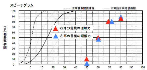 こちらは、語音明瞭度測定の結果。補聴器の世界には、音声の理解度を調べる測定がある