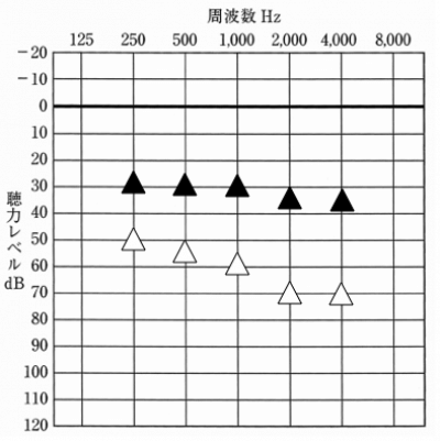 補聴器を装用すると音の質も変化する