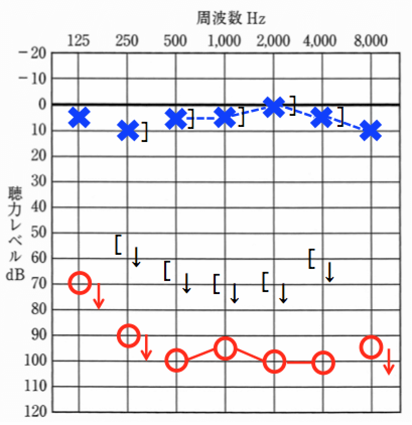 クロス補聴器は、片耳が極端に聞きにくい方に有効