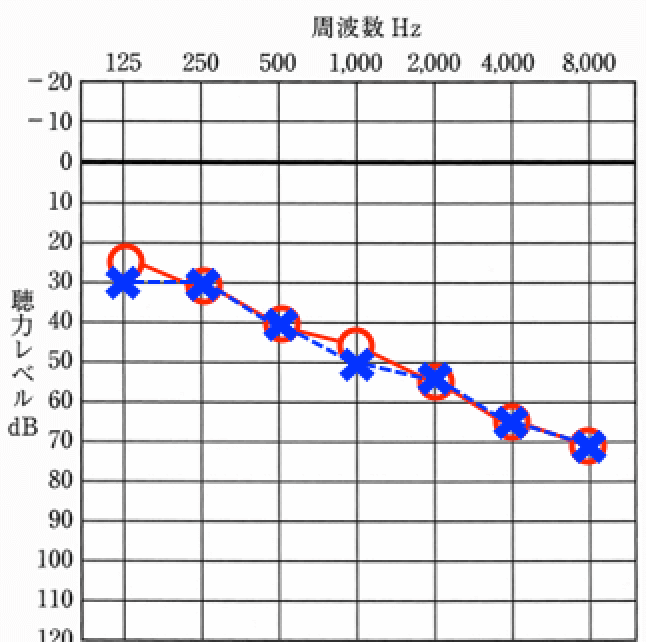 老人性難聴の聴力例、基本的に低い音は聞こえやすく、高い音が聞きにくくなる傾向がある
