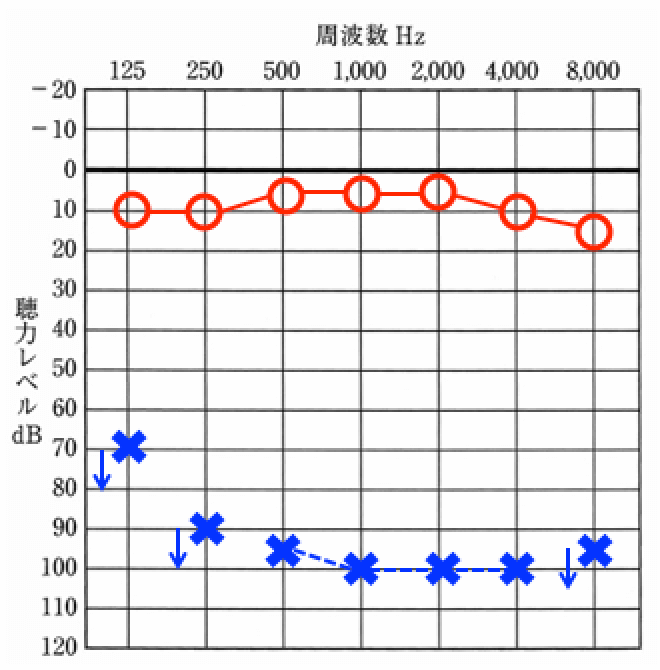 突発性難聴の聴力例、片耳に発症し、片耳の聞こえが極端に低下する事が多い