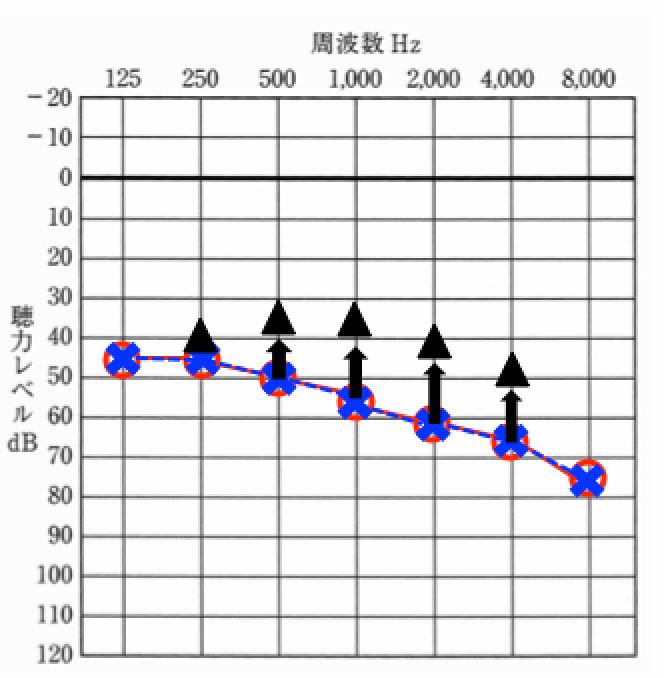基本的に補聴器は、聴力を良くさせる機器。装用する事で、画像のように聴力が良くなる。