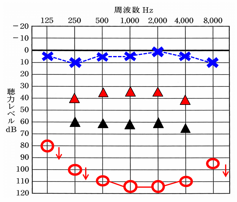 右側の聴力が下がっていると仮定。▲が補聴器を装用した効果。赤い△は、補聴器で効果を望むのに必要な数値。補聴器は、聴力が低下するとするほど、効果が薄くなる。