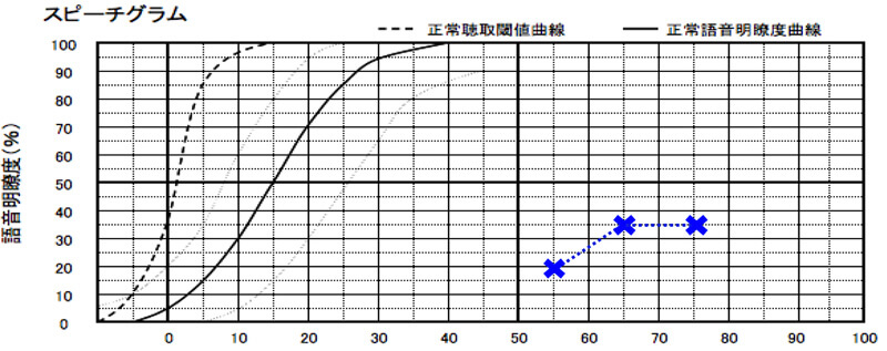 音を大きくして言葉を聞かせても、伸びなかったケース。このように伸びにくい場合は、補聴器を装用しても、この通り伸びにくい傾向があります。