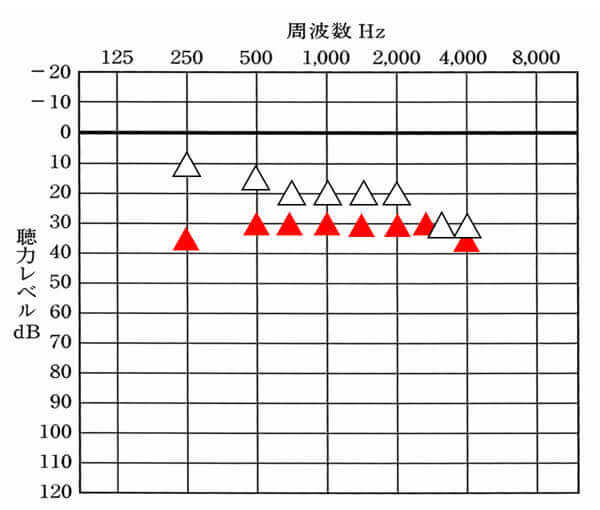 補聴器で改善できる数値より同じ、もしくは、それより上の場合は、残念ながら補聴器の効果は薄くなる。