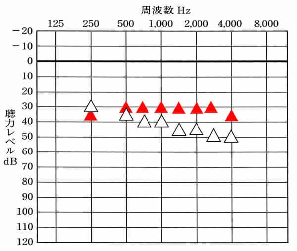 補聴器で改善できる数値よりも下にある場合は、改善できる見込みがある。ぜひ試聴してみて、どう聞きにくさ、不便さが改善できるのかを確認した方がいいだろう。