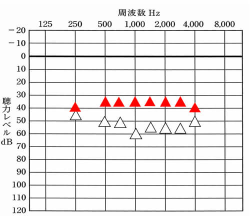 ▲が補聴器での改善目標値。△が補聴器なしの状態の数値。こちらは、音場閾値測定というものでの数値。