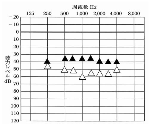 初回時の耳かけ形の数値。非常に良い数値で、かつ騒がしい事はないとのこと。