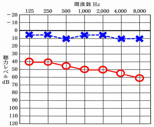 片耳は、聞こえていて(左側)、もう片耳は、中等度の難聴(右側)の典型的な例。