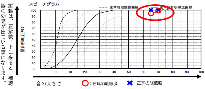 測定結果を見てみると、右も左も、ほぼ100%で、効果が出やすい耳であることがわかりました。