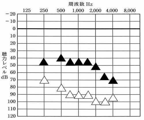高度難聴以上については、基本的に聴覚医学会の内容で計測。低い音(250Hz〜500hz)は上がりやすく、750Hz、1000Hz、1500Hzも頑張ればできるケースがあるが、2000Hz辺りから、かなりきつくなり、半分は、目指せないことが多い。