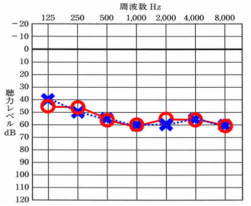 左右とも同じケースでは、左右の補聴器を個別に調整しない限りは、ズレることは、少ない。ただ、体感でも良いので、違いがないかは、確認しておこう。