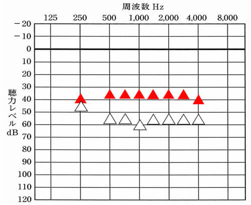 軽度〜中等度難聴の場合は、このくらいまで改善できると良い。500Hz〜3000Hzは、35dB、250Hz、4000Hzは、40dBになる。