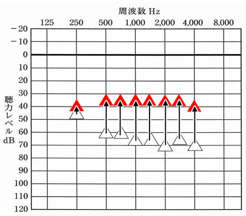 赤い△が改善目標値。△は、補聴器なしの状態の聞こえ。私の場合、低い音よりも高い音の方が聞きにくくなっているので、その部分を中心に改善していく必要がある。