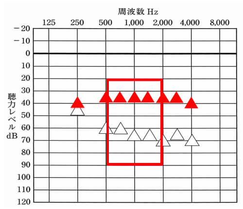 改善する際に意識しておきたいのは、どの部分まで改善させられると良いか。という視点になる。私のような聴力の場合、聞こえを改善させたいなら、500〜2000Hzは、35dBまでは、改善させたい。ここまで改善できると、少し小さい声の方の声から少し声の大きい方の声まで、全体的に改善しやすくなるため、聞きにくさを減らしやすい。