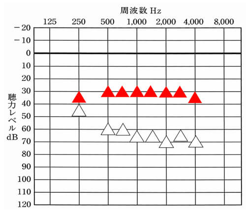 全体的に30dBまで改善ができるとさらに小さい声の方の音量も聞きやすくなる。ただし、周囲の音など大きくなる要素もあるので、あくまでも目指せる方のみここまで改善すると良い。無理やり皆瀬させても辛くなるだけなので、適度に改善は、行おう。