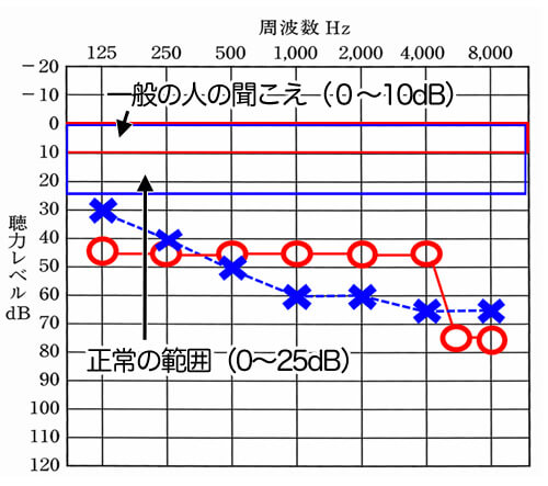 一般の方は、ほぼ0〜25dbで聞こえており、0〜25dBまでは、正常の範囲内。聴力データは、一般的な聞こえの部分から、どれだけ下がっているのか。を見れるようになっている。