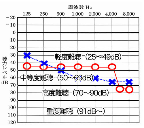 25dBより下がると、基本的に何らかの聞きにくさを感じるようになる。そのレベルにより、難聴の程度が分かれるようになっている。