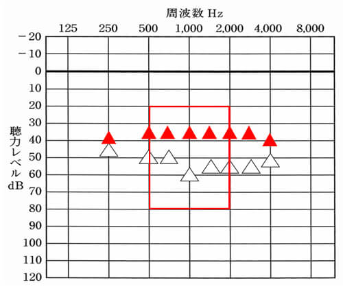 補聴器で聞きにくさを改善させる場合、なるべくこの辺りは、改善させたい。音声の聞こえに影響するため、この部分を改善目標値まで近づけられたり、その部分まで、できると、改善しやすい。