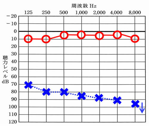 こちらは、聴力図。右が○、左が×。下に行くと行くほど、聞きにくくなる状態。聴神経腫瘍の場合、腫瘍がどのように内耳を圧迫しているかにより、状況が異なりますが、このように大きく低下したり、高い音(2000Hz以上の音)が急激に下がったりするようなケースが多い。