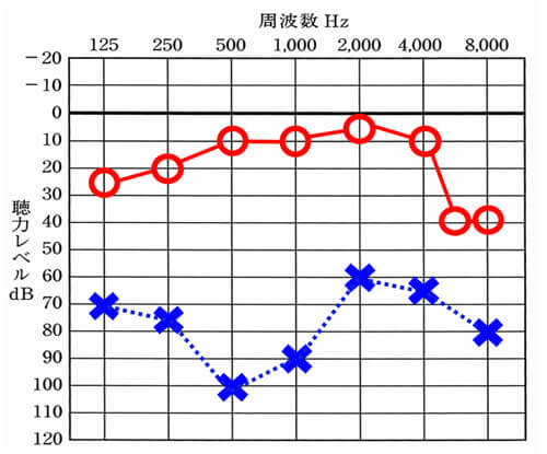 ○が右側、×が左側を表します。上にあると上にあるほど、聞こえはよく、右側は、ほぼ正常の範囲。左側は、難聴の中でも重い方になる高度難聴くらいです。このくらいまで聴力が下がると、左側が聞こえる感覚は、あまり感じなくなります。